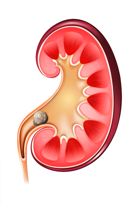 SOS Cólica Renal